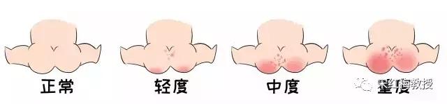 宝宝嘴唇红屁股红,宝宝嘴唇红怎样调理