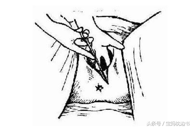 顺产要侧切还是顺切,侧切和不侧切无撕裂有什么区别