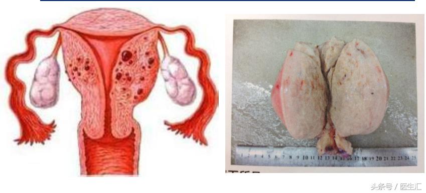 月经量多、阴道出血！小心子宫腺肌症！