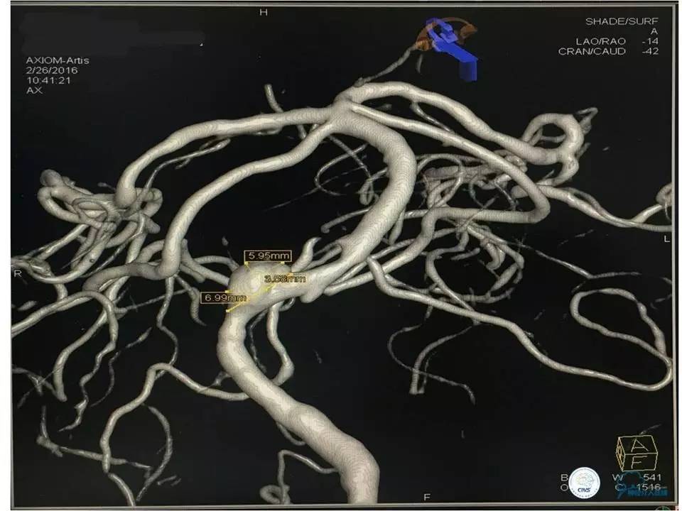 脑动脉瘤并颈动脉狭窄怎么治疗,脑动脉血管狭窄介入治疗效果好吗