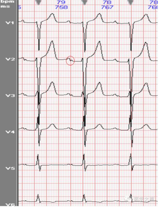 心电图课堂第22期,儿童心电图左室肥大怎么回事