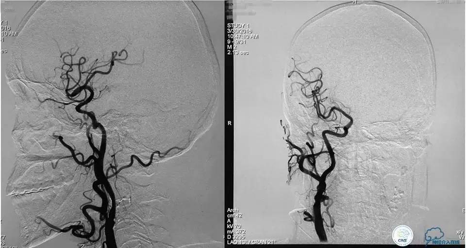 脑动脉瘤并颈动脉狭窄怎么治疗,脑动脉血管狭窄介入治疗效果好吗