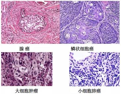 鉴别肿瘤良恶性最简单有效的方法,增强ct判断良恶性肿瘤准确率高吗