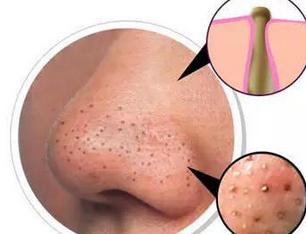 去黑头最彻底的偏方小妙招,去黑头的最好方法妙招科普