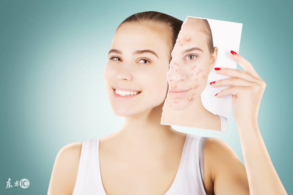 青少年痤疮特别严重用什么药膏,青少年痤疮最佳治疗方法