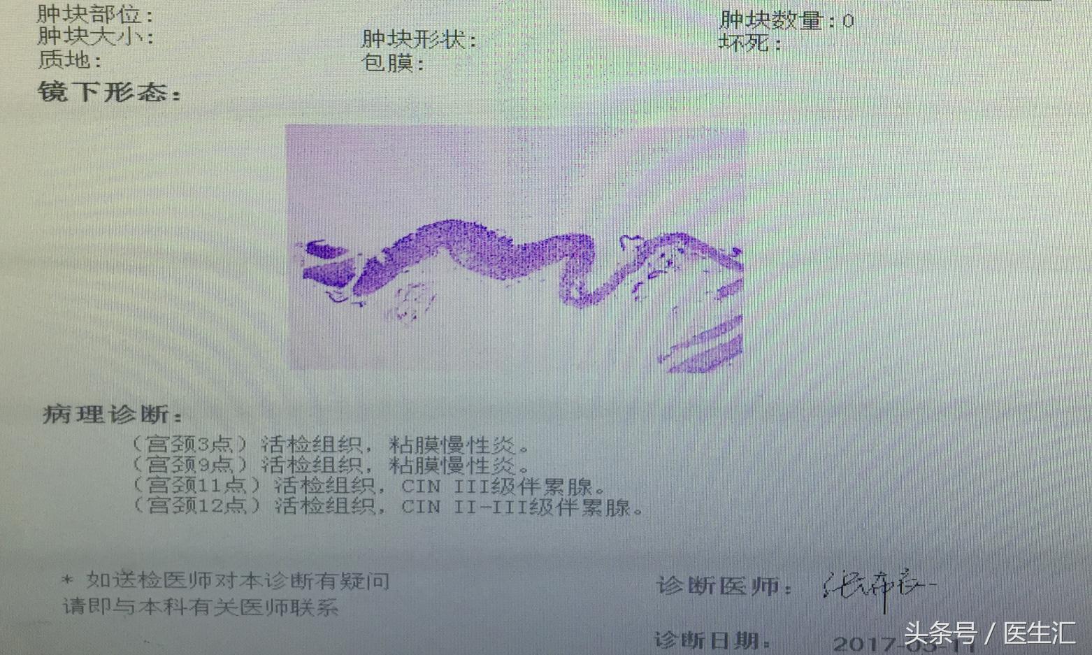 子宫腺肌症打闭经针出血还是很多,子宫腺肌症经期出血量大怎么治疗