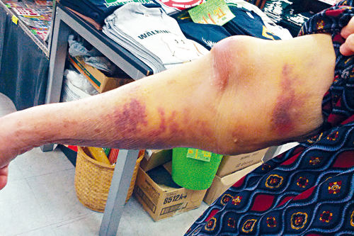 手指采完血针眼鼓包,采完血气胳膊为什么很酸