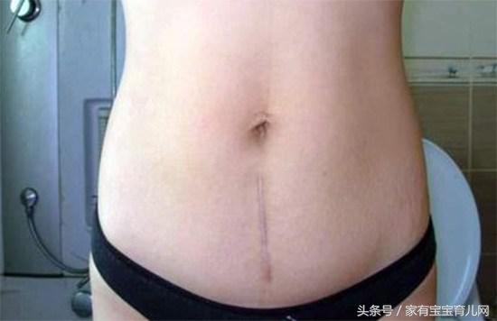 剖腹产横切好还是竖切好？原来有这么多缝合方式，你是属于哪种？