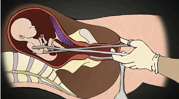 堕胎时人类是怎样一步步杀死自己孩子的?妈妈会看哭!