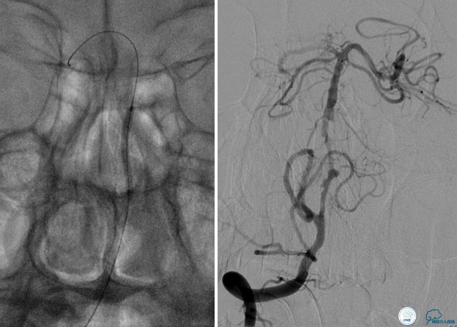 颅内动脉狭窄介入治疗研究,颅内血管cta副作用
