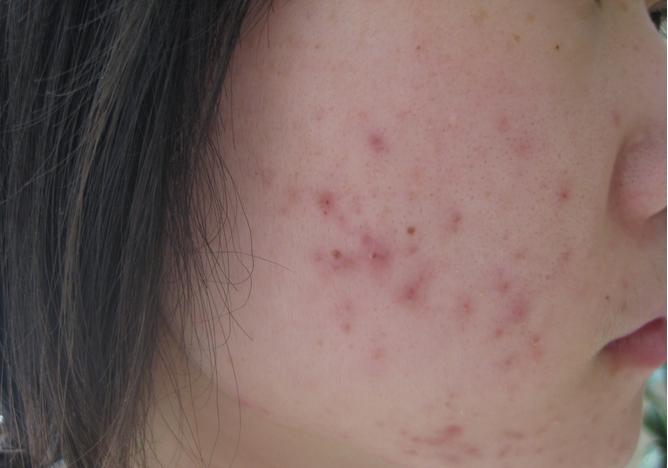 背后每年秋冬长痘怎么治,经常长痘的肤质怎样避免长痘