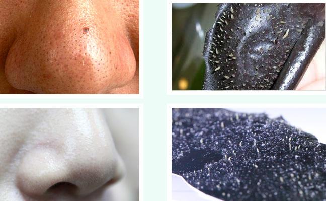 鼻尖上有黑头是怎么回事,鼻尖挤出黑头留下一个坑