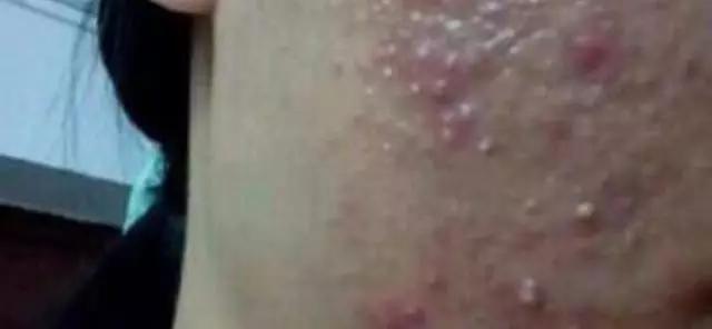 挤痘痘的正确手法图解,挤痘不留印的正确方法