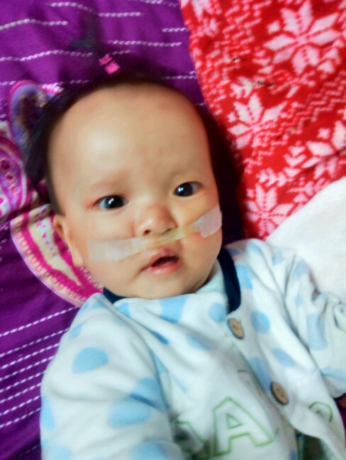 婴儿单纯先天裂唇7毫米,先天性腭裂是什么