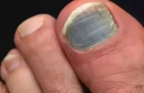 小脚趾甲黑了怎么回事,小脚趾甲黑是怎么回事