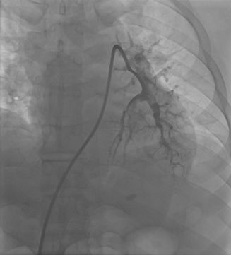 急性心梗病例讨论的意义,急性肺栓塞和急性心肌梗死