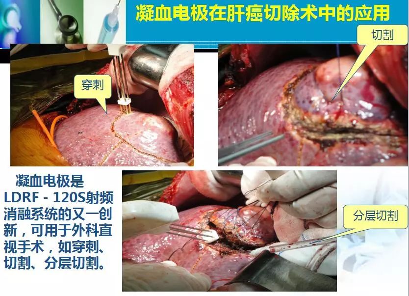 胆管肿瘤射频消融术,肿瘤射频消融厂家