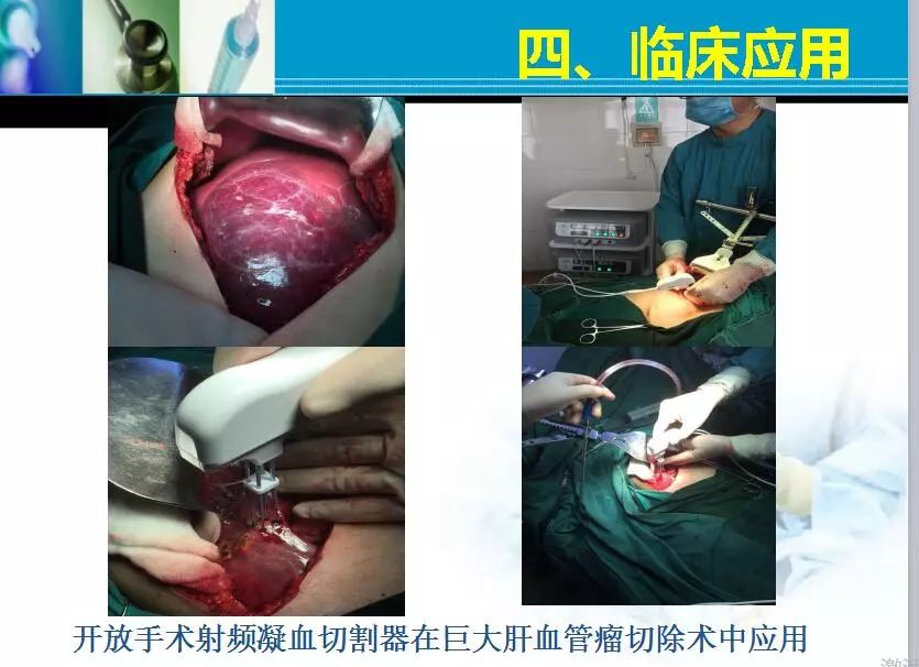 胆管肿瘤射频消融术,肿瘤射频消融厂家