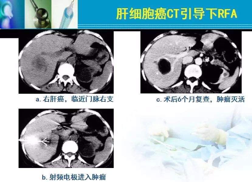 胆管肿瘤射频消融术,肿瘤射频消融厂家