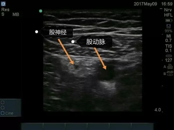 超声引导隐神经阻滞视频教学,超声引导下腰椎旁神经阻滞视频