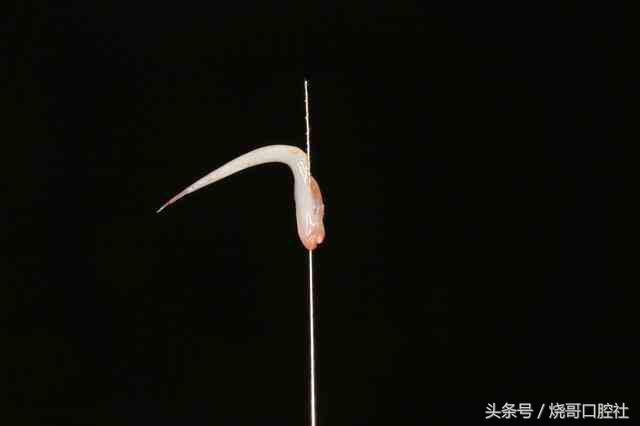 小孩牙齿根管治疗危害,根管治疗牙齿松动了能恢复吗