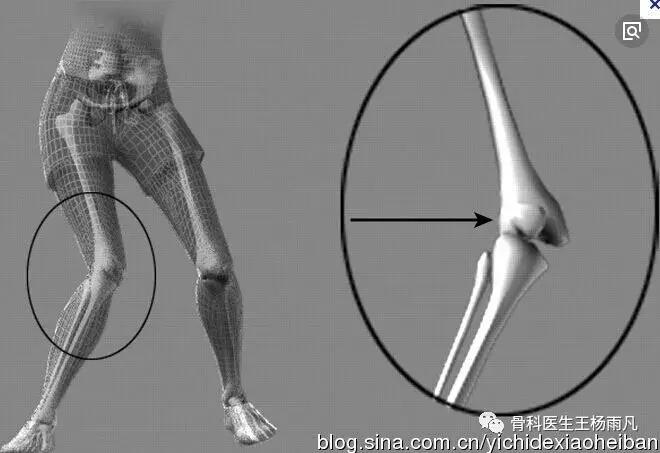 前叉重建人工韧带容易断裂吗,前叉十字韧带断裂怎么康复