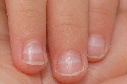宝宝的健康也可从指甲中判断,宝宝指甲不健康的六个表现