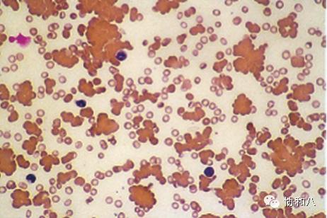 是COOMBS，不是Combs|一页手册·协和八