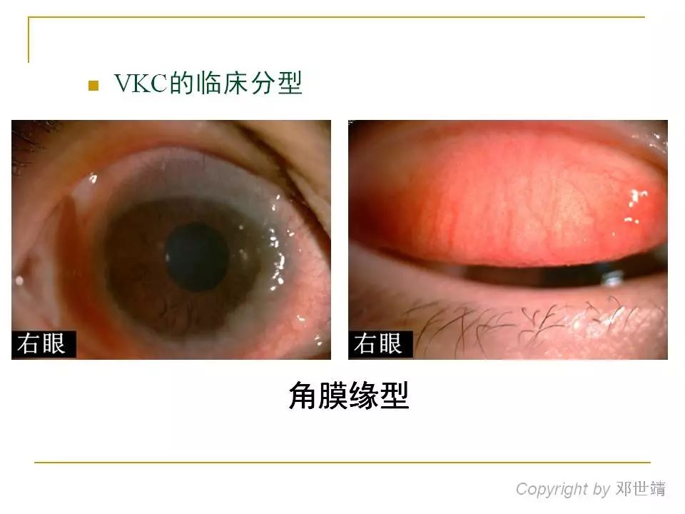 眼周过敏中医治疗,眼周过敏的症状图片