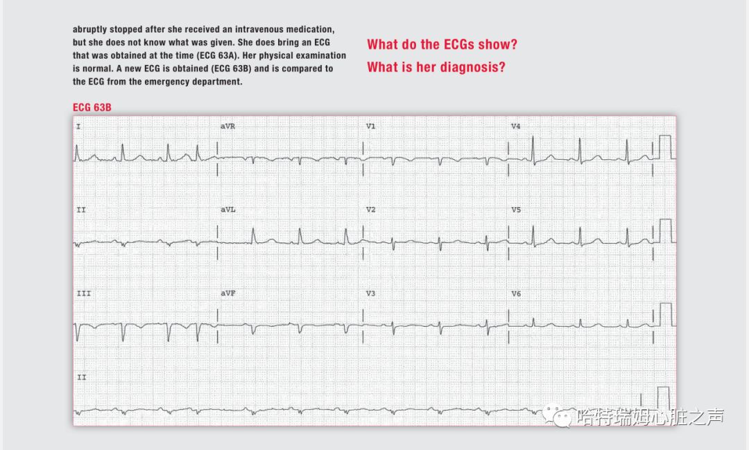 「读心有术」329期:电轴极度左偏,病因有两种