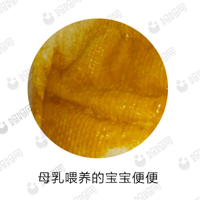 宝宝拉这几种便便要去医院,宝宝有问题的便便是怎样的