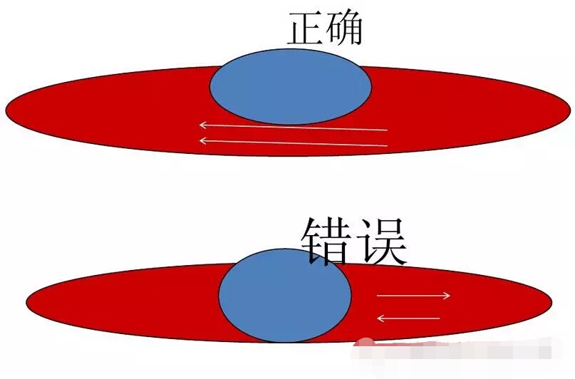 日常怎样保护内瘘,透析病人怎么保护内瘘