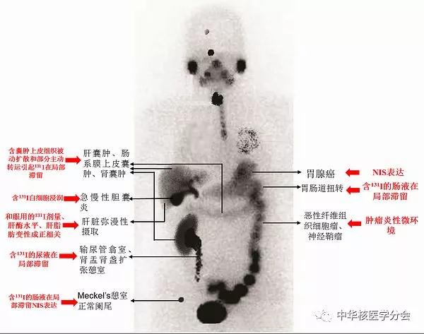 甲状腺癌进行碘治疗后有什么反应,甲状腺癌碘治疗后淋巴还有结节