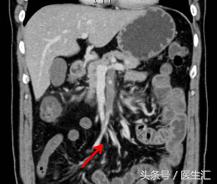 呕吐吐出咖啡色液体怎么回事,呕吐出黄色液体后怎么处理
