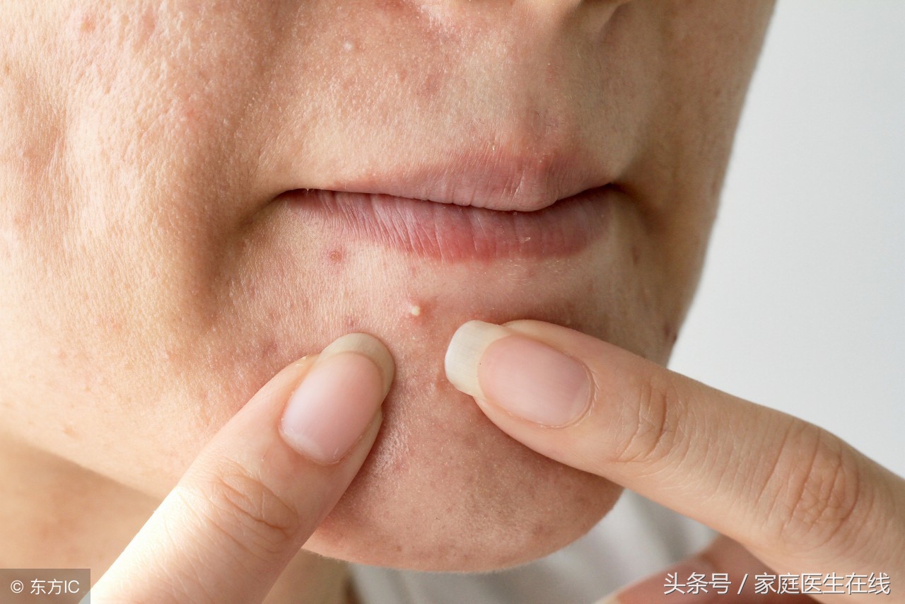 皮肤科医生建议去黑头的最好方法,皮肤科医生教你如何去黑头