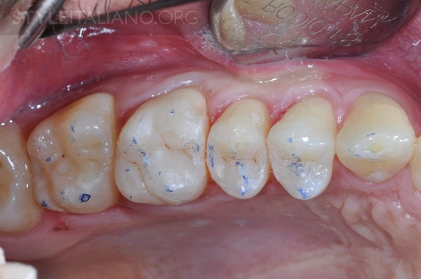 后牙修补贴片,后牙全瓷修复图片