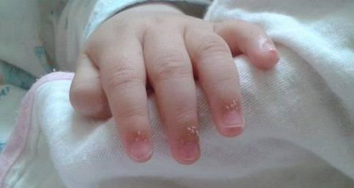 手指甲附近有倒刺是缺啥,孩子手指甲有竖纹是缺啥维生素