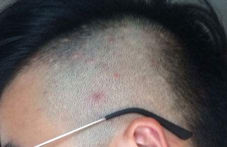 头皮痒长痘痘怎么办用什么洗头,头皮长疮发痒痛怎么治