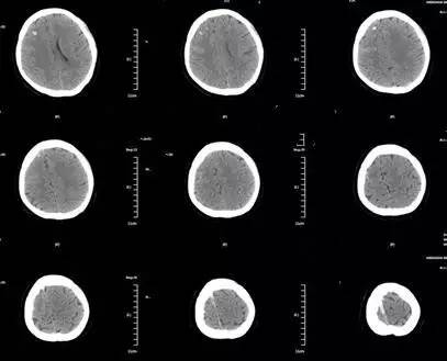 颅内静脉窦血栓ct特征,颅内静脉窦血栓的定性诊断