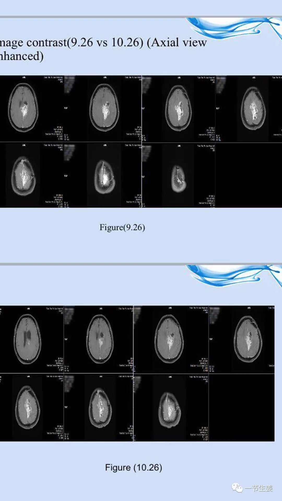 脑胶质瘤可以用免疫疗法吗,脑胶质瘤用哪种放疗机器