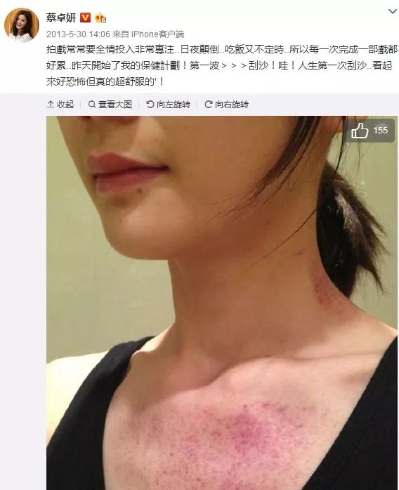 阿娇刮痧后背效果,阿娇背部刮痧图片