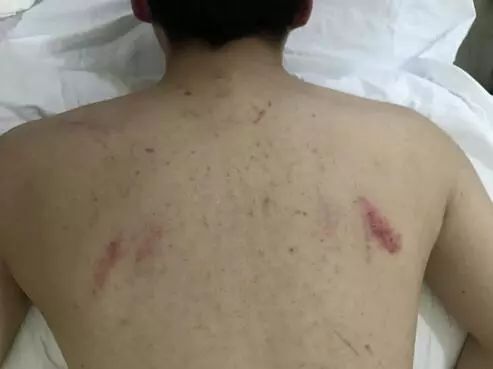 阿娇刮痧后背效果,阿娇背部刮痧图片