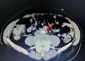 出血原因千千万，此例患者为哪般？