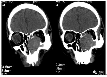 73岁患者因左鼻塞流脓涕4个月入院，CT发现一软组织高低混杂密度，怎么诊断？