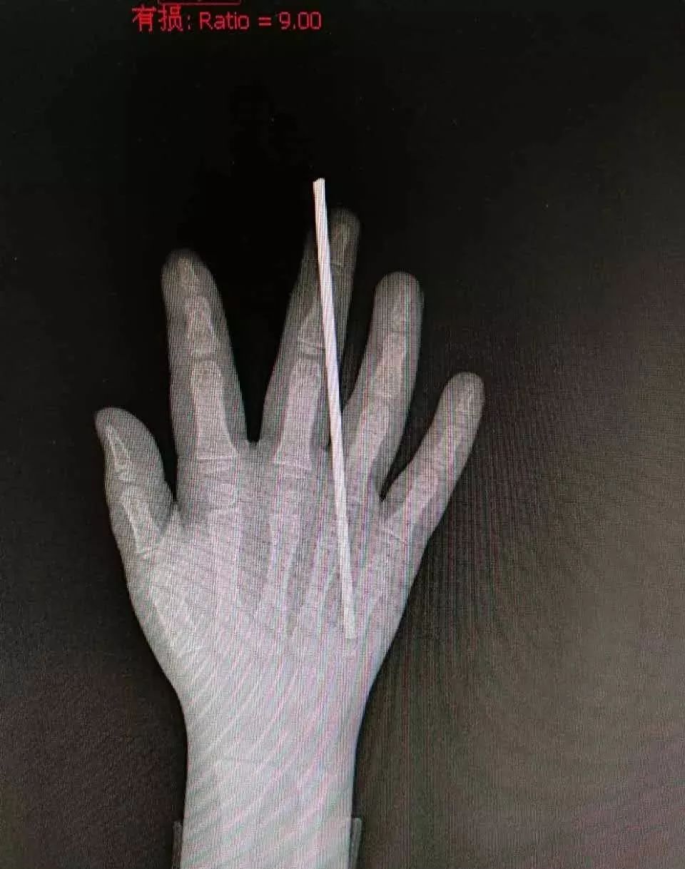 疼！家长们注意：熊孩子这样玩，钢丝刺穿右手中指！