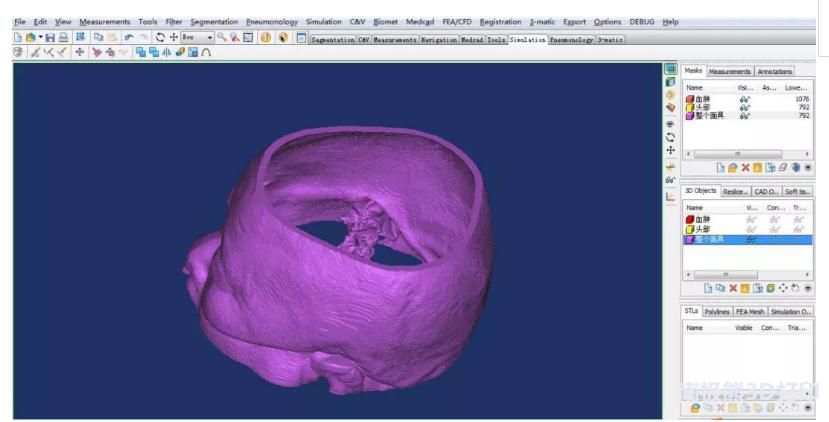 医学3d动画演示脑出血手术,3d演示脑出血治疗过程
