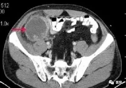 阑尾炎特殊检查讲解视频,阑尾炎病例分析的模板