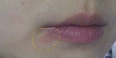 敷面膜过敏脸上满脸疙瘩怎么消除,别再乱敷面膜了敷对时机很重要