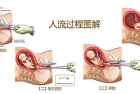 人流的最佳时间,人流后复查b超最佳时间