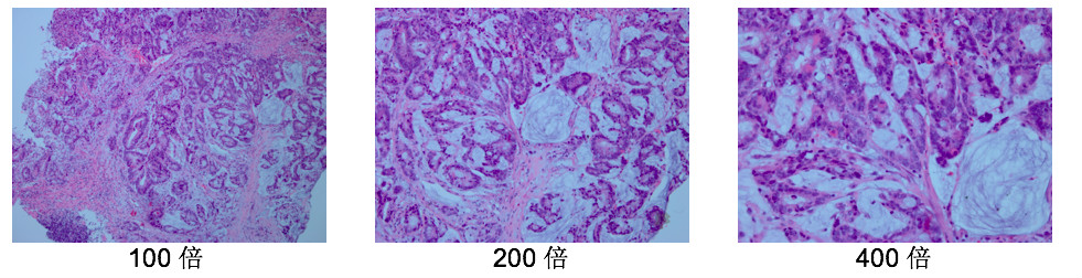 直肠腺癌肺转移最好的治疗方案,得了直肠腺癌不治疗能活几年